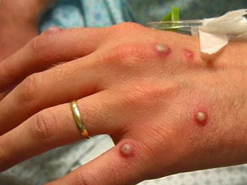 Reporta Ssa 91 casos de viruela símica en el país