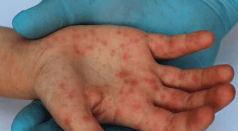 7 formas de reducir riesgo de contagiarse de viruela símica