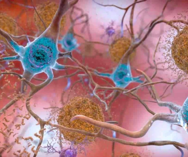 Nuevo fármaco frena avance de Alzheimer en un 60%