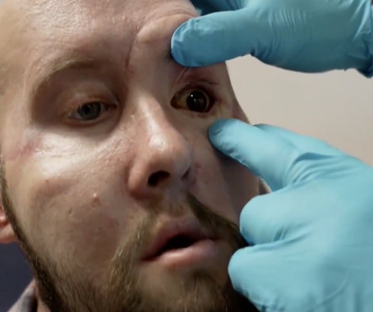 Primer trasplante de ojo en el mundo: Un éxito medico