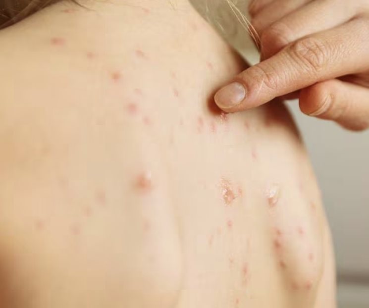Preocupa aumento de casos de sarampión en Europa