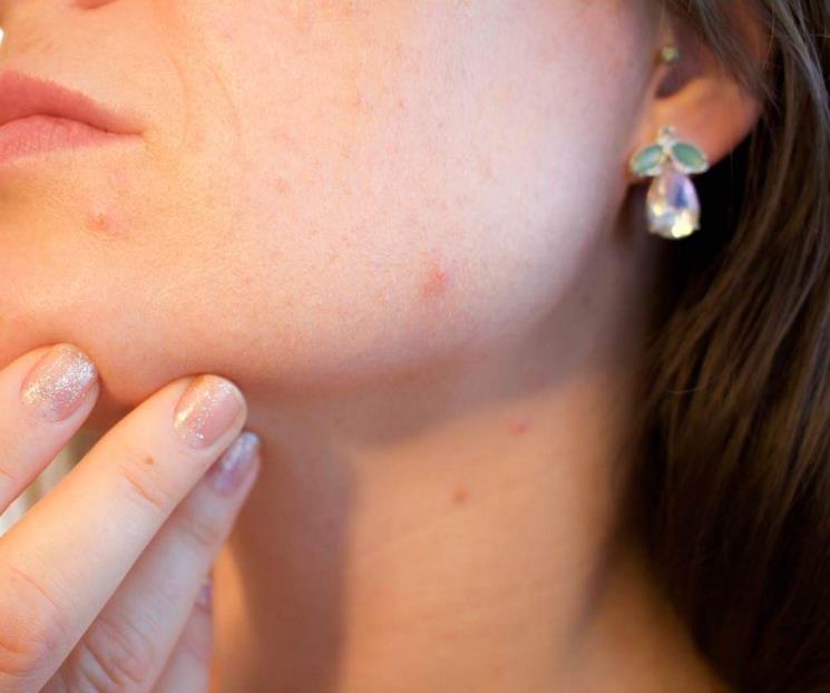El tratamiento contra el acné que usa bacterias para combatirlo