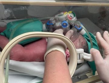 Una de las bebés siamesas separadas en Nuevo León es dada de alta