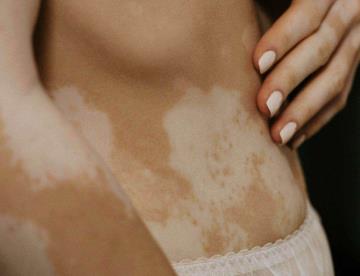 Enfrenta vitiligo mitos que rodean a la enfermedad