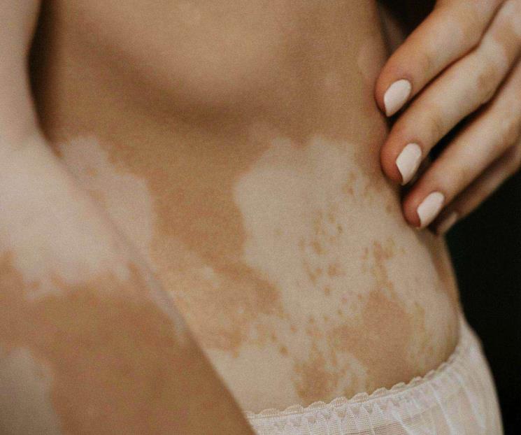 Enfrenta vitiligo mitos que rodean a la enfermedad